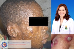 มารู้จักโรคฝีดาษลิง (monkeypox)